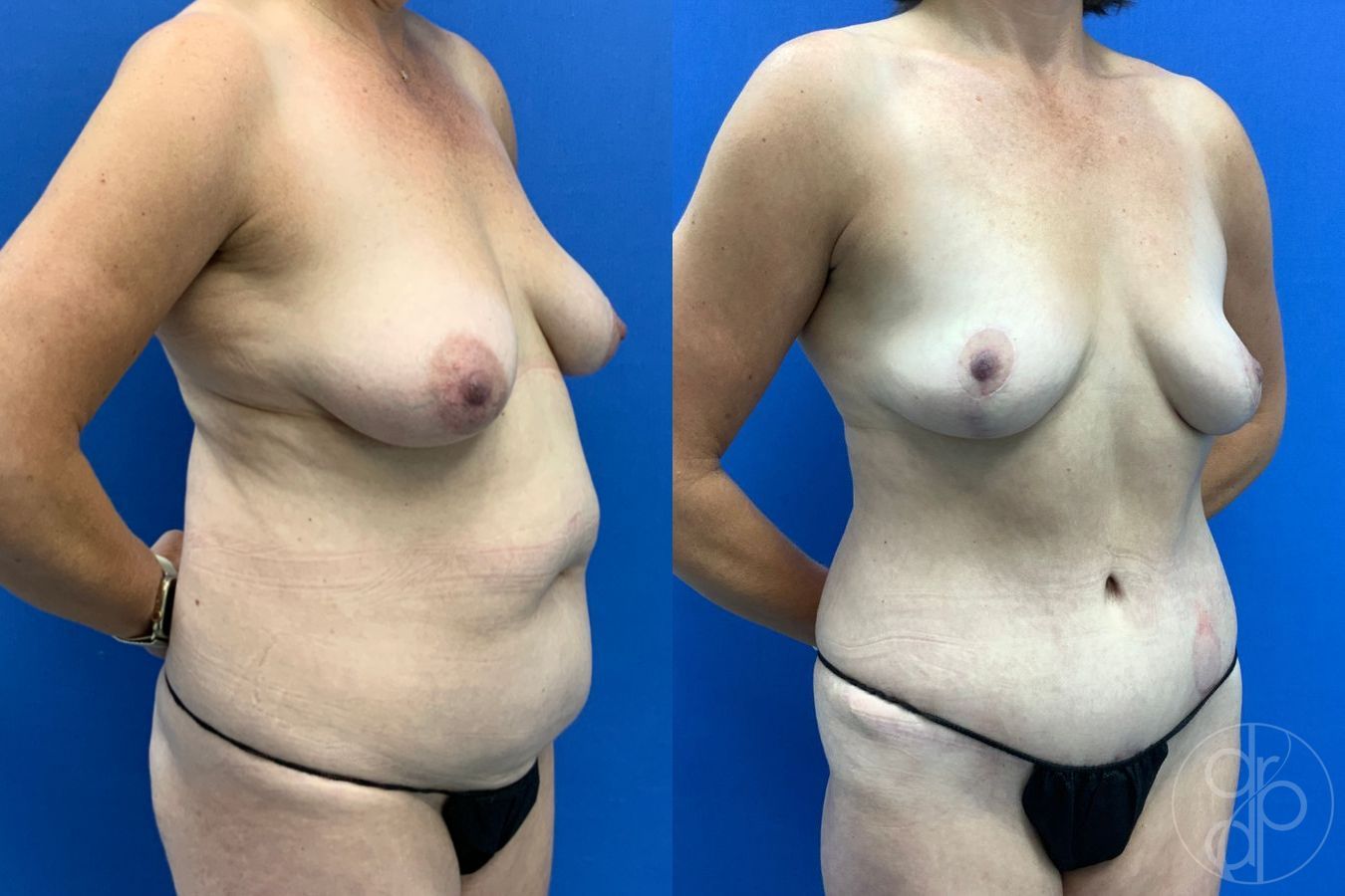 Before and after Abdominoplasty case 46268 - Angle 4