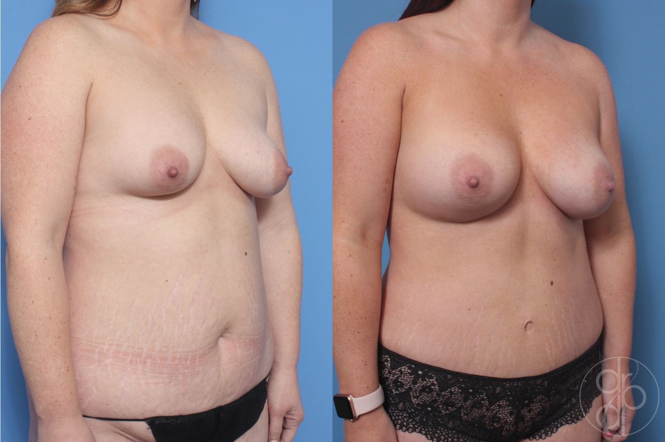 Before and after Tubular Breast Surgery case 29829 - Angle 2