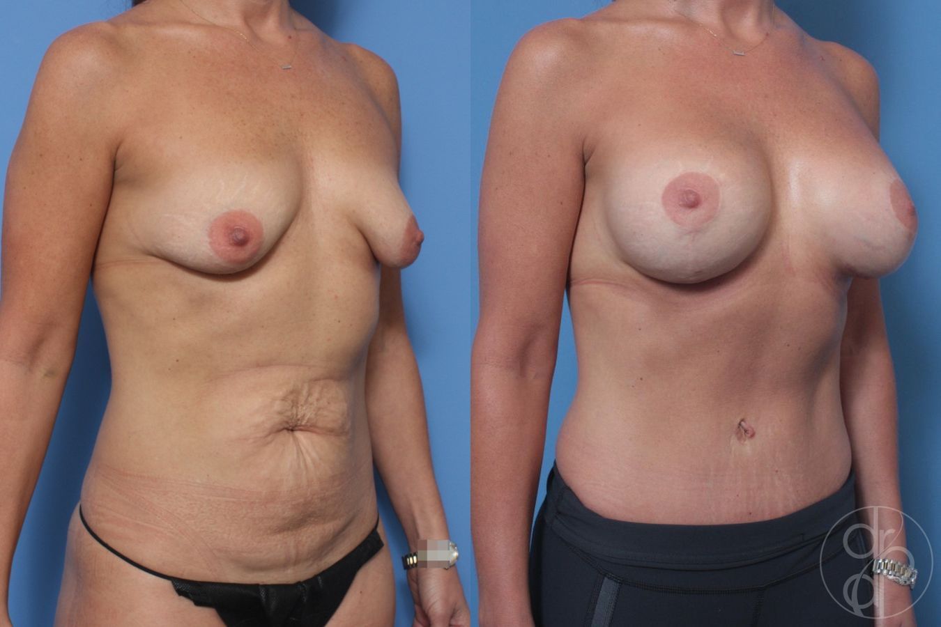 Before and after Breast Augmentation with Lift case 29890 - Angle 3