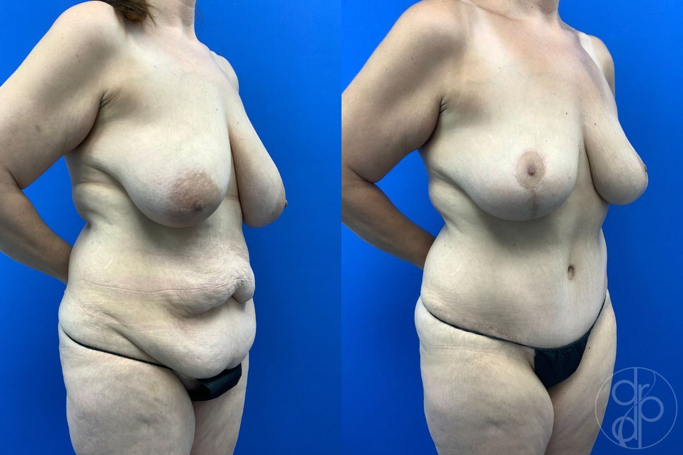 Before and after Mommy Makeover case 43478 - Angle 3