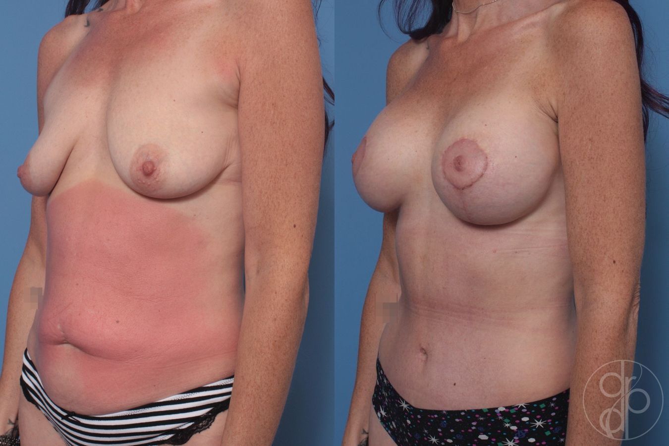 Mommy Makeover - Thumbnail 3