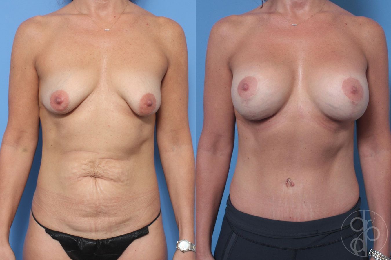 Before and after Breast Augmentation with Lift case 29890