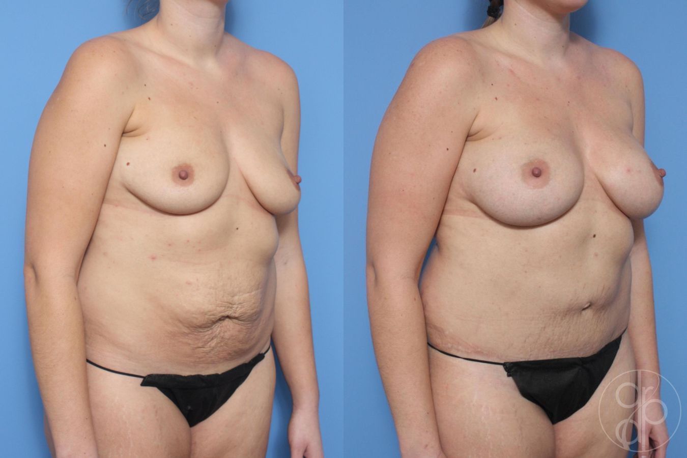Before and after Mommy Makeover case 29618 - Angle 4