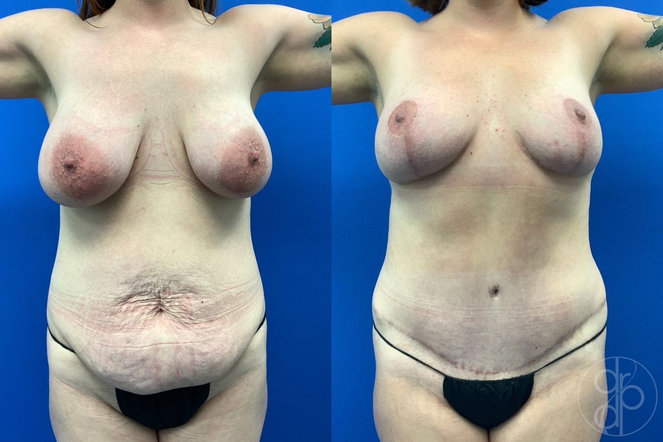 Before and after Mommy Makeover case 43477 - Angle 2
