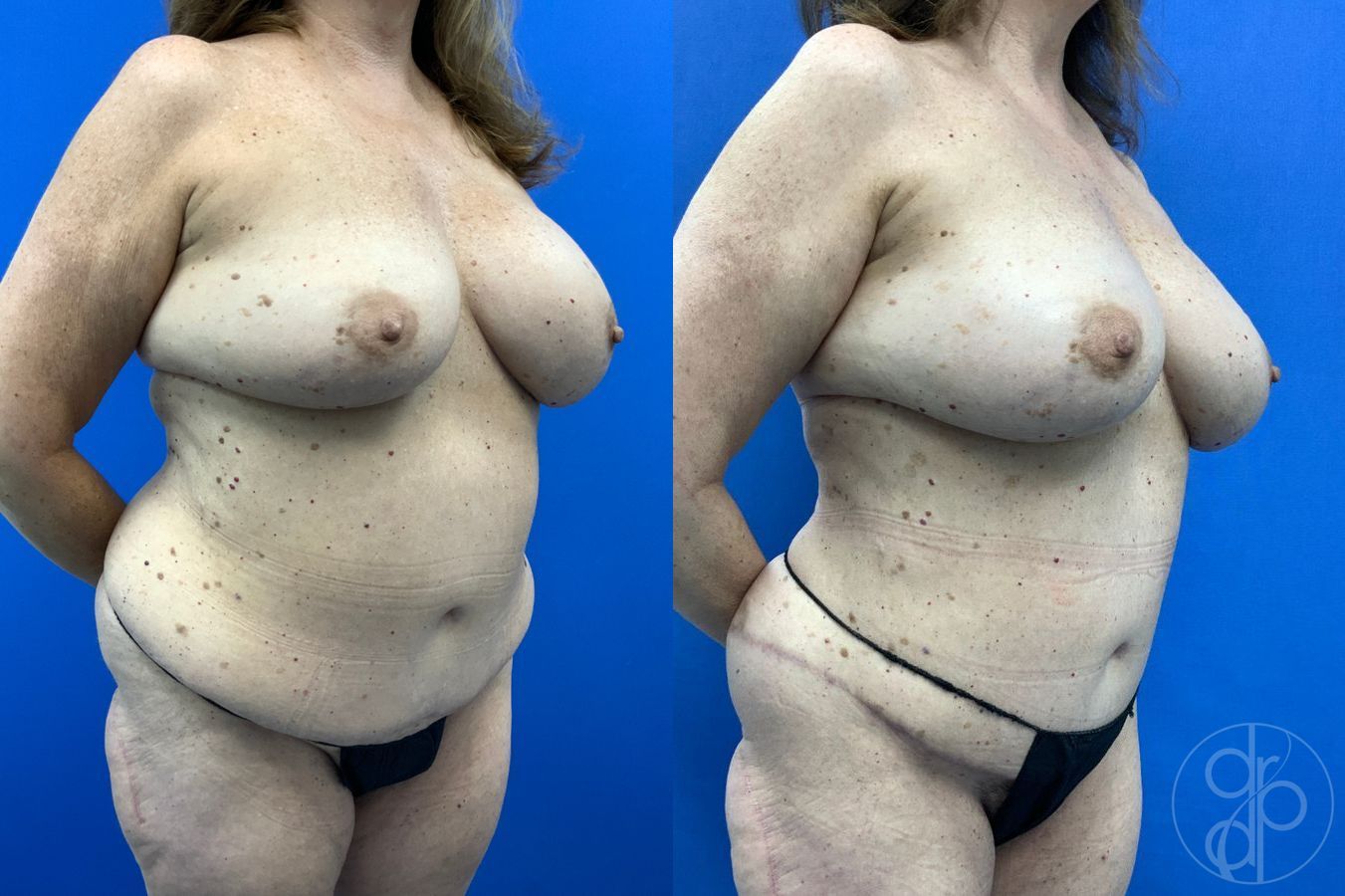 Before and after Mommy Makeover case 46273 - Angle 7