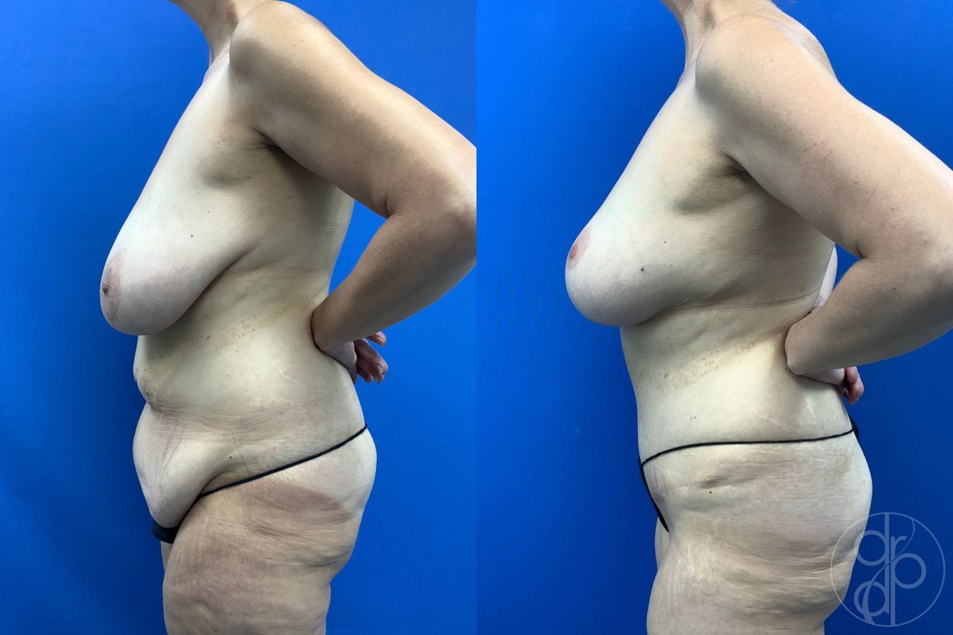 Before and after Breast Reduction case 43471 - Angle 6