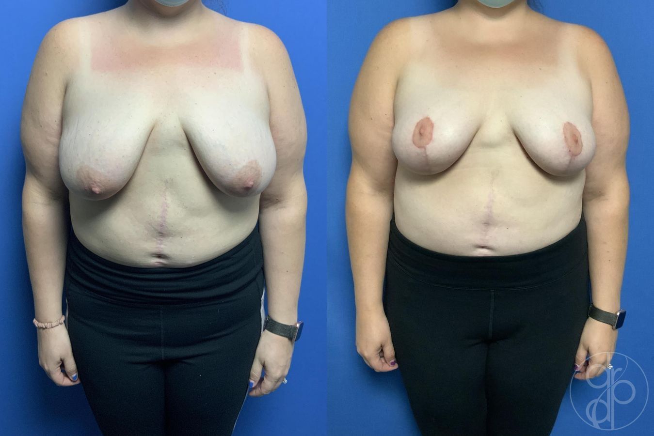 Before and after Mommy Makeover case 29982 - Angle 4