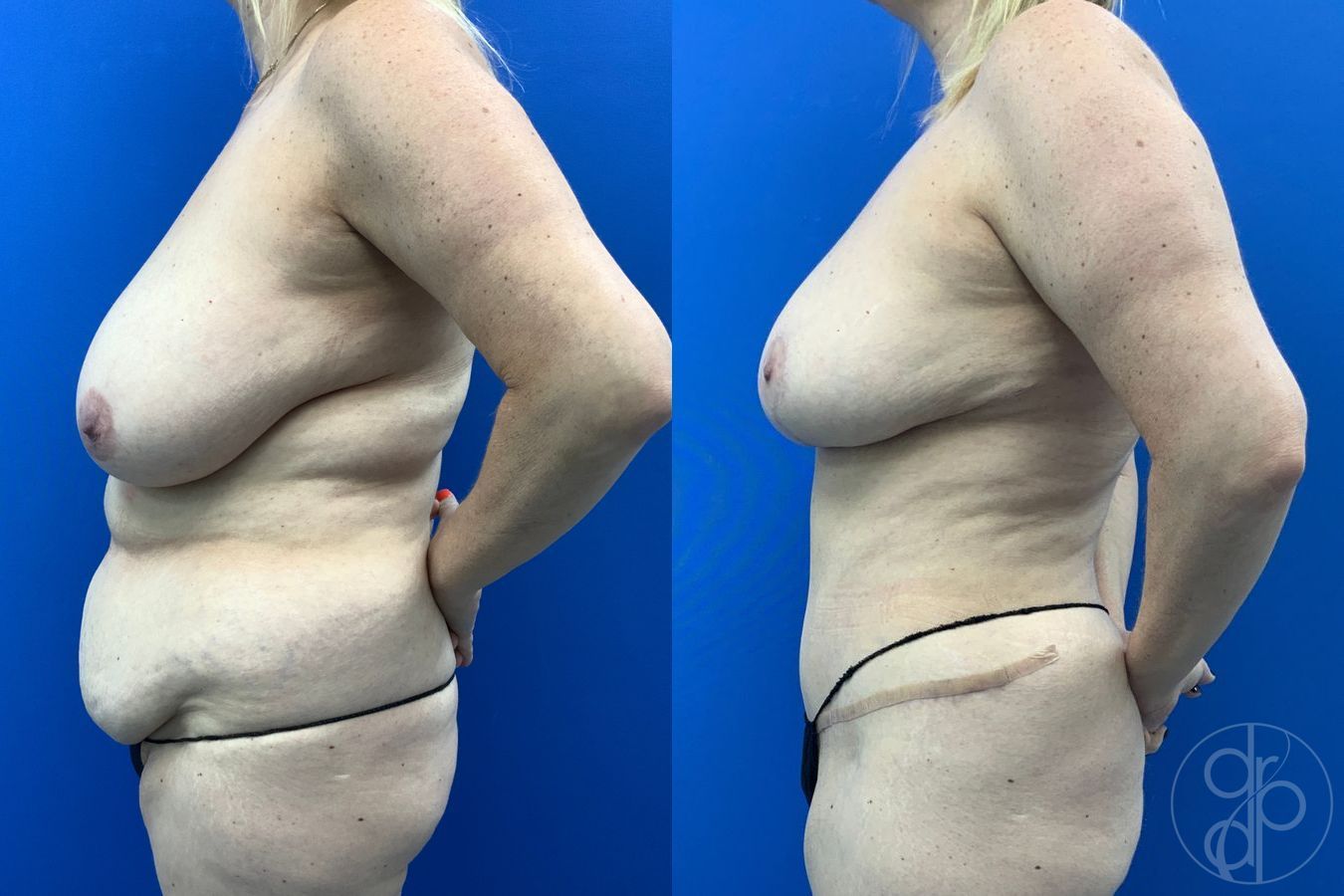 Before and after Abdominoplasty case 46355 - Angle 4