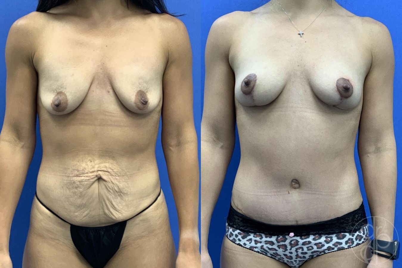 Before and after Mommy Makeover case 29755