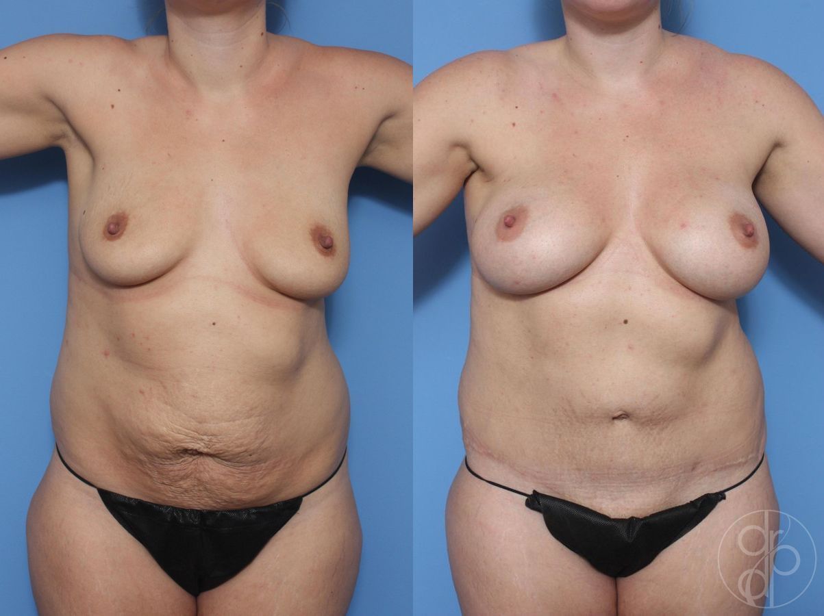 Before and after Mommy Makeover case 29618 - Angle 2