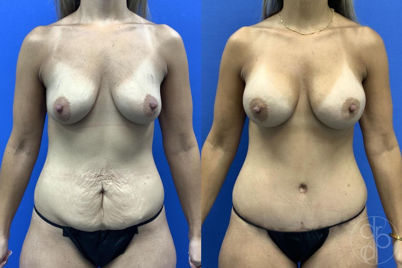 Before and after Mommy Makeover case 30011