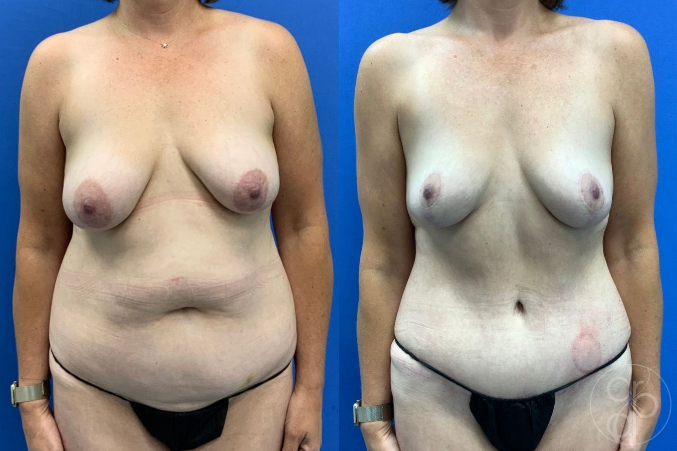Before and after Abdominoplasty case 46268