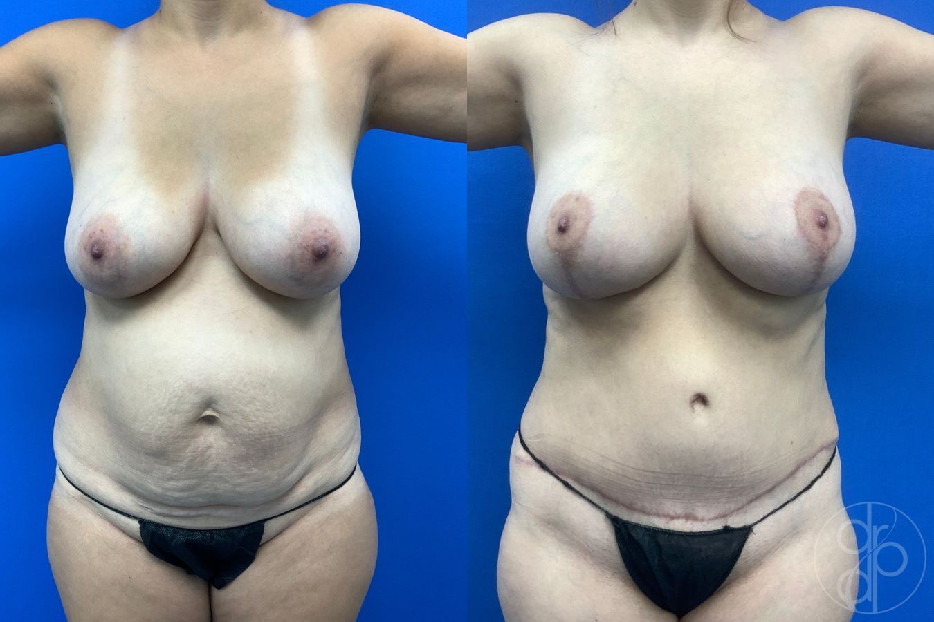 Before and after Abdominoplasty case 43462 - Angle 2