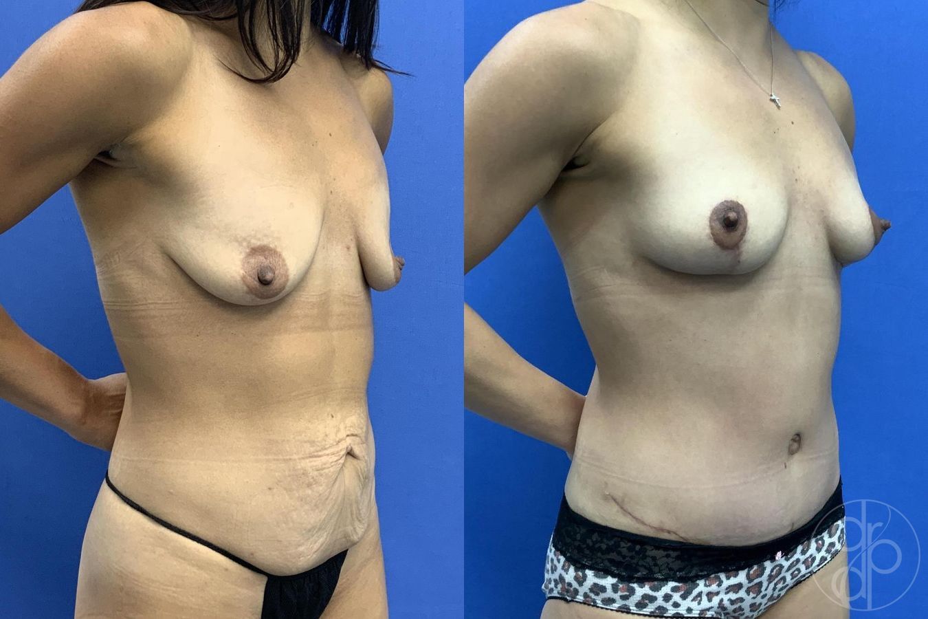 Before and after Mommy Makeover case 29755 - Angle 4