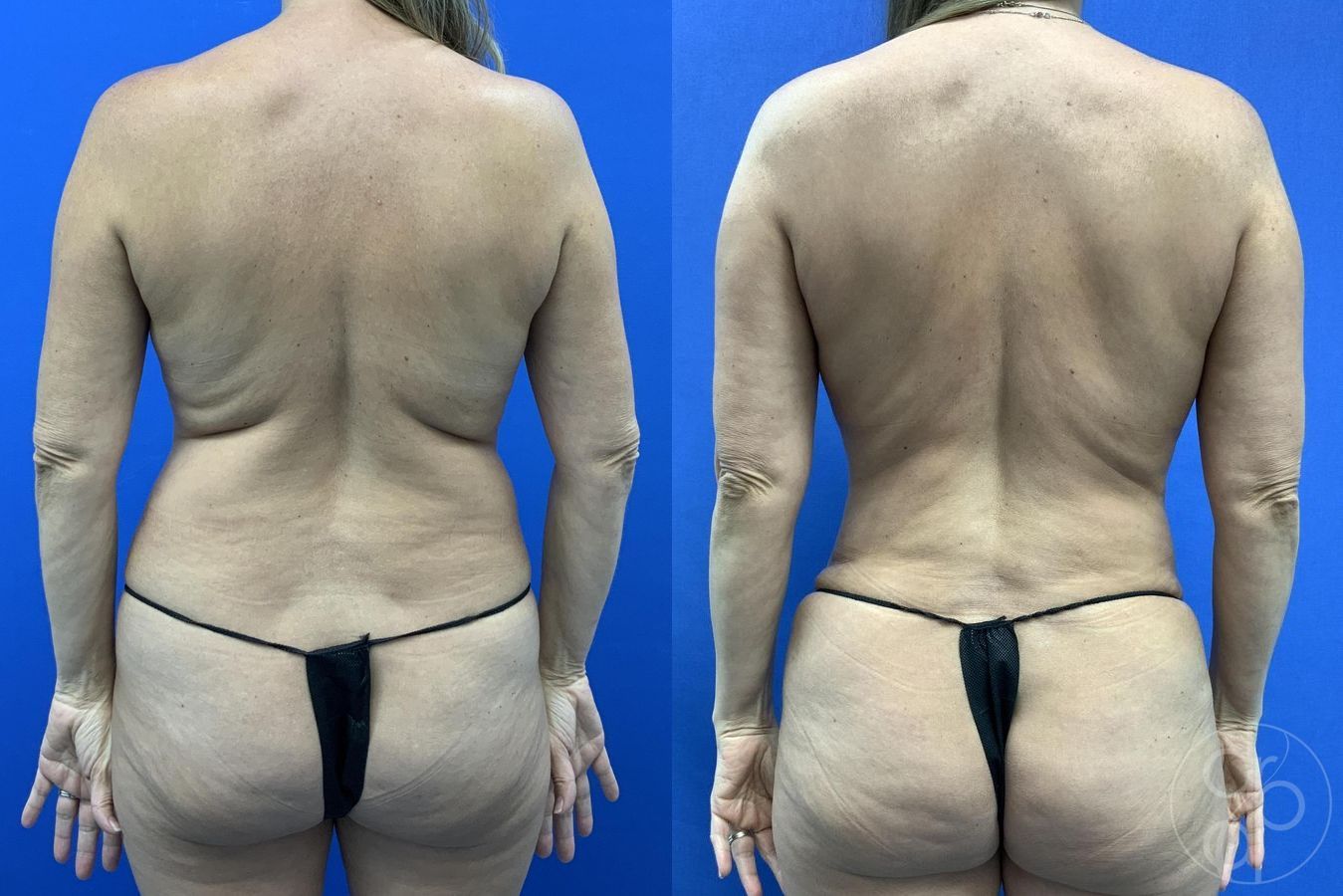 Before and after Mommy Makeover case 29660 - Angle 7