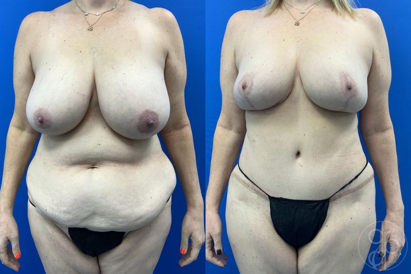 Before and after Abdominoplasty case 46355