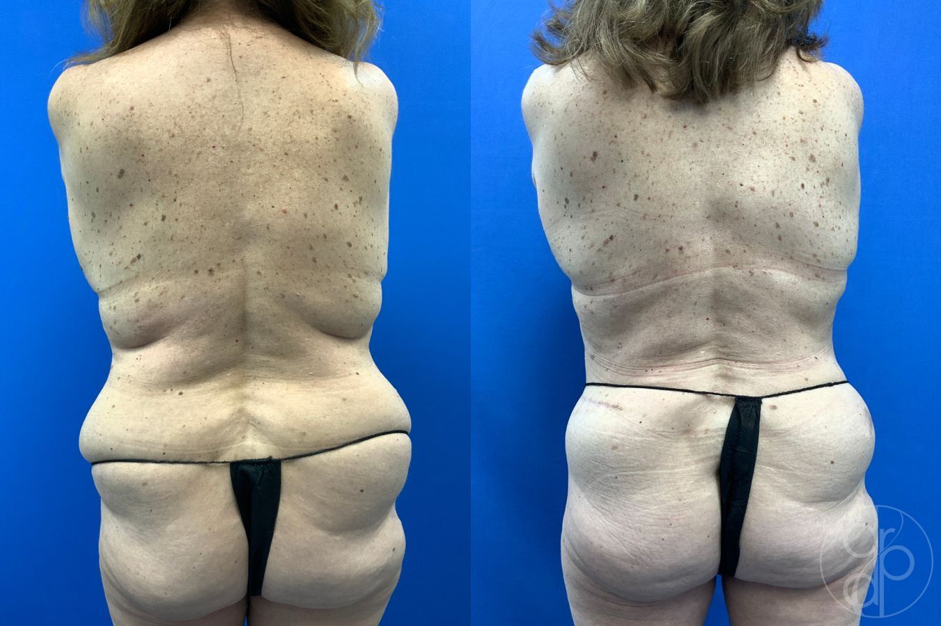Before and after Mommy Makeover case 46273 - Angle 5