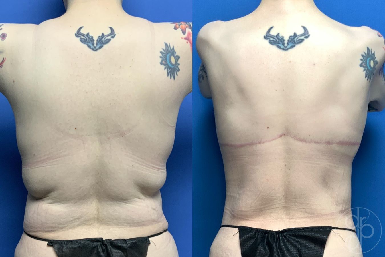 Before and after Breast Implant Removal with Lift case 29816 - Angle 4