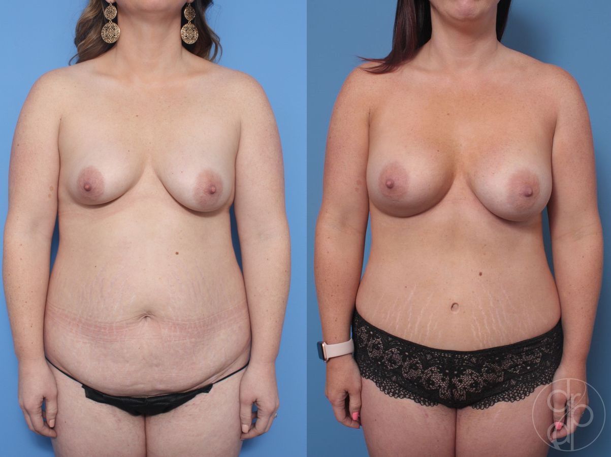 Before and after Mommy Makeover case 29829
