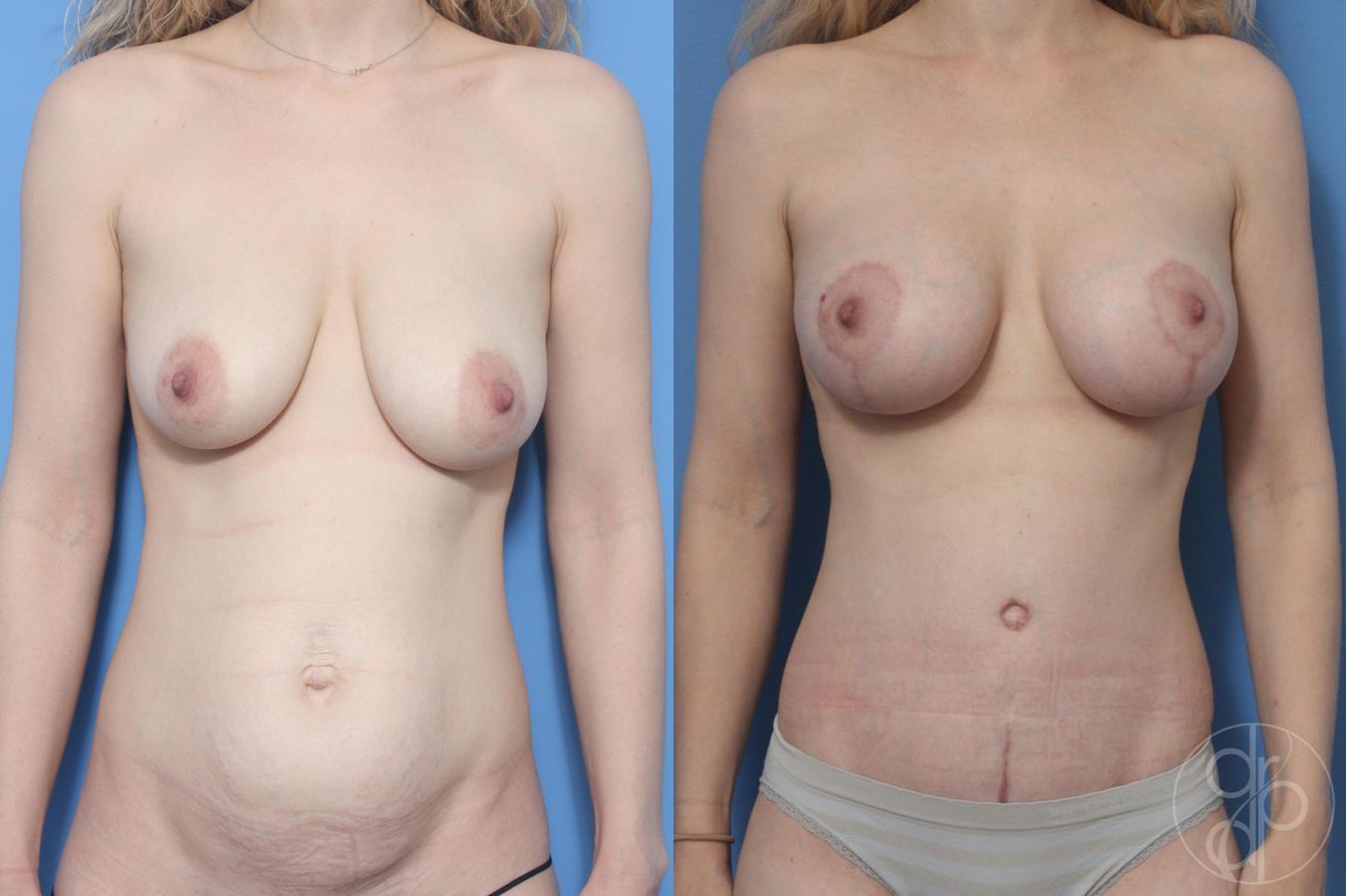 Before and after Tummy Tuck case 29610