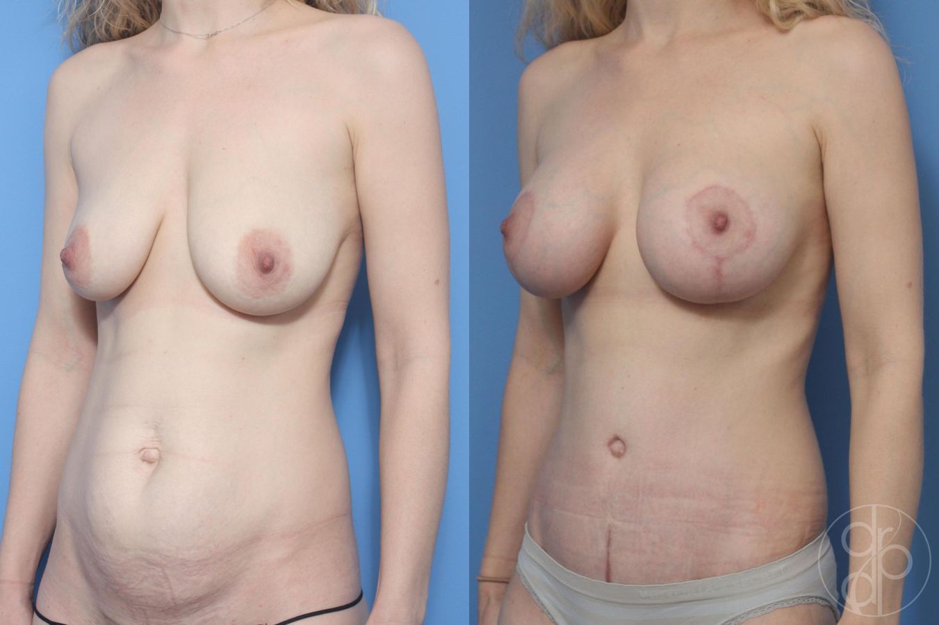 Before and after Tummy Tuck case 29610 - Angle 3