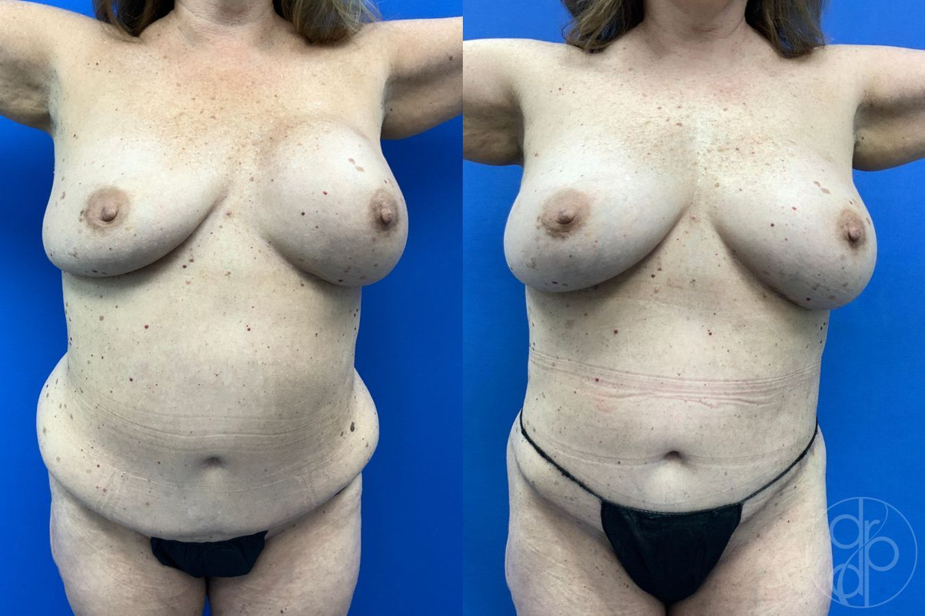 Before and after Mommy Makeover case 46273 - Angle 2
