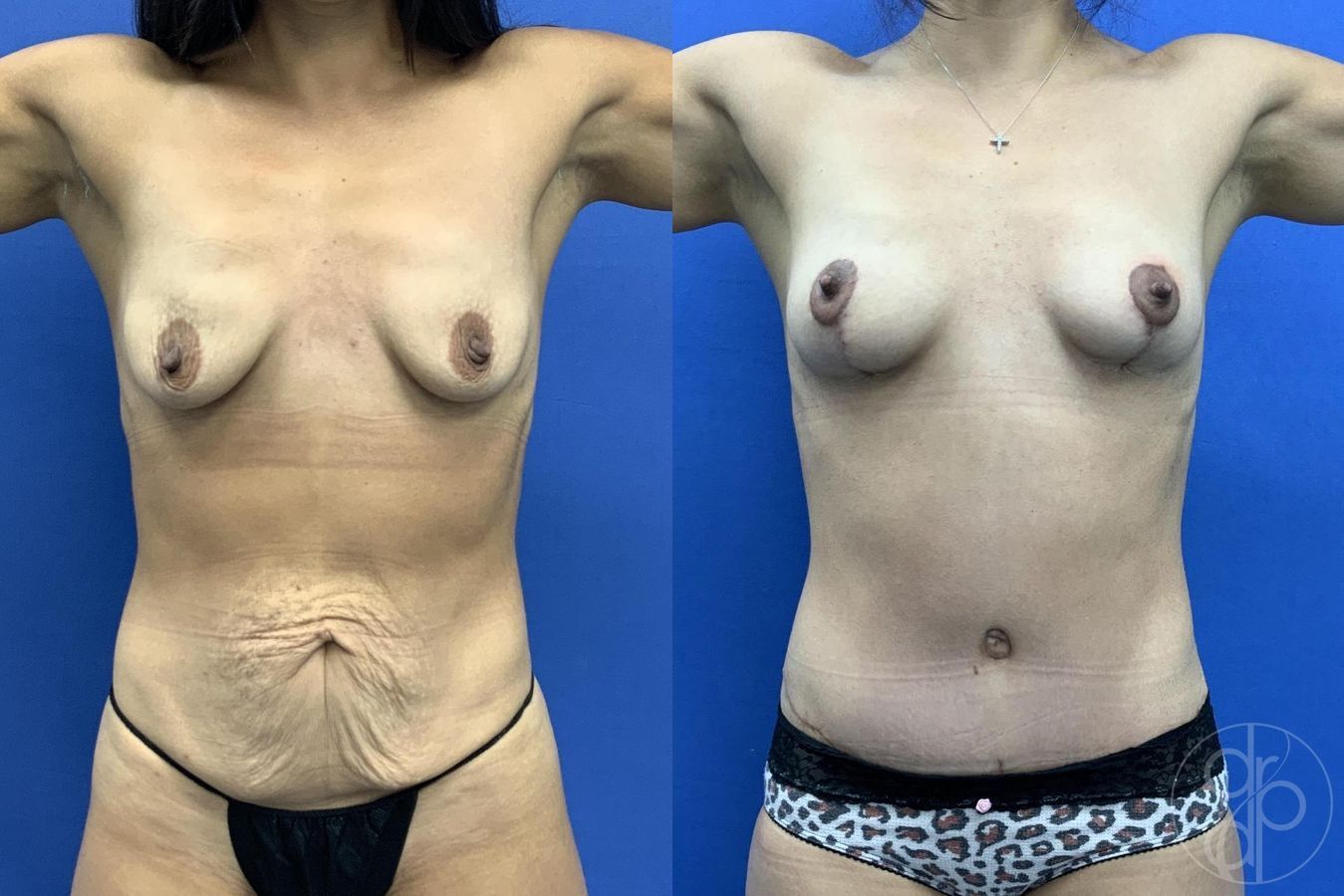 Before and after Mommy Makeover case 29755 - Angle 2