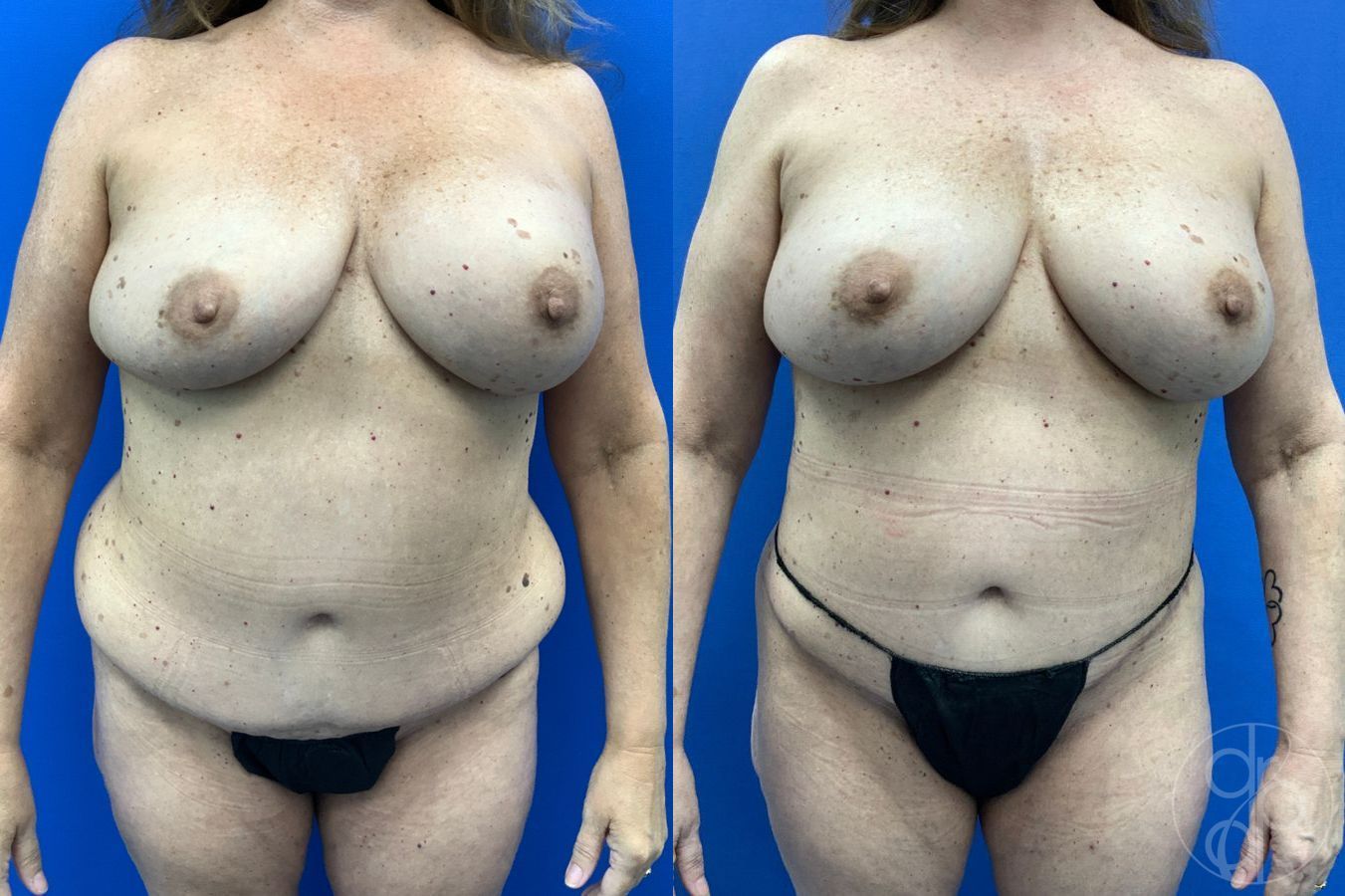Before and after Mommy Makeover case 46273