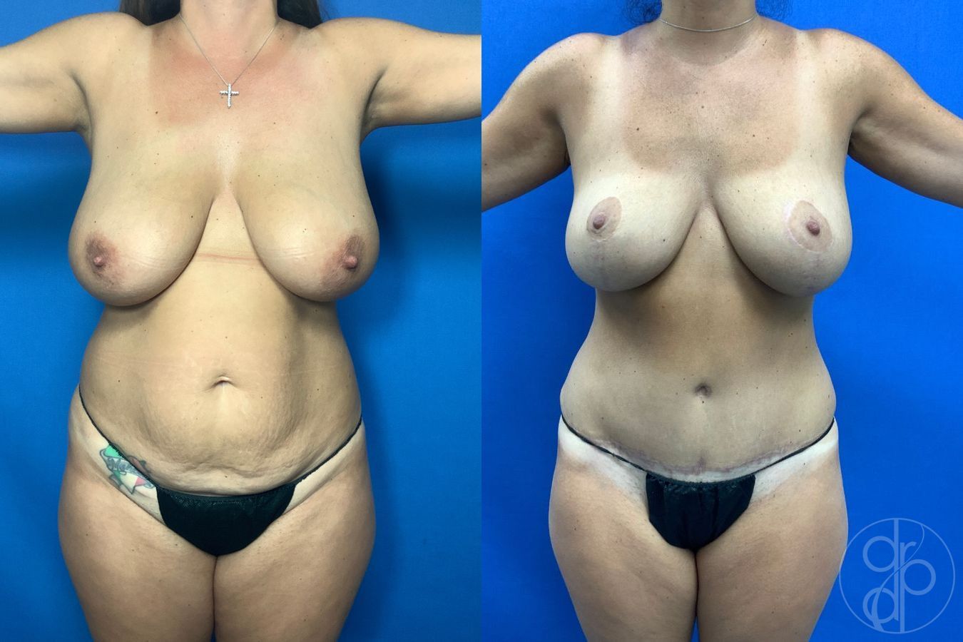 Before and after Mommy Makeover case 43479 - Angle 2