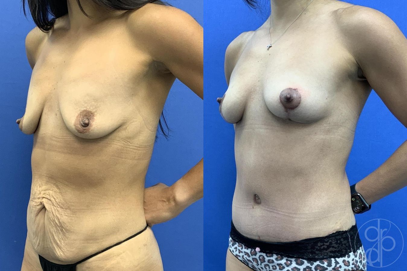 Before and after Mommy Makeover case 29755 - Angle 3