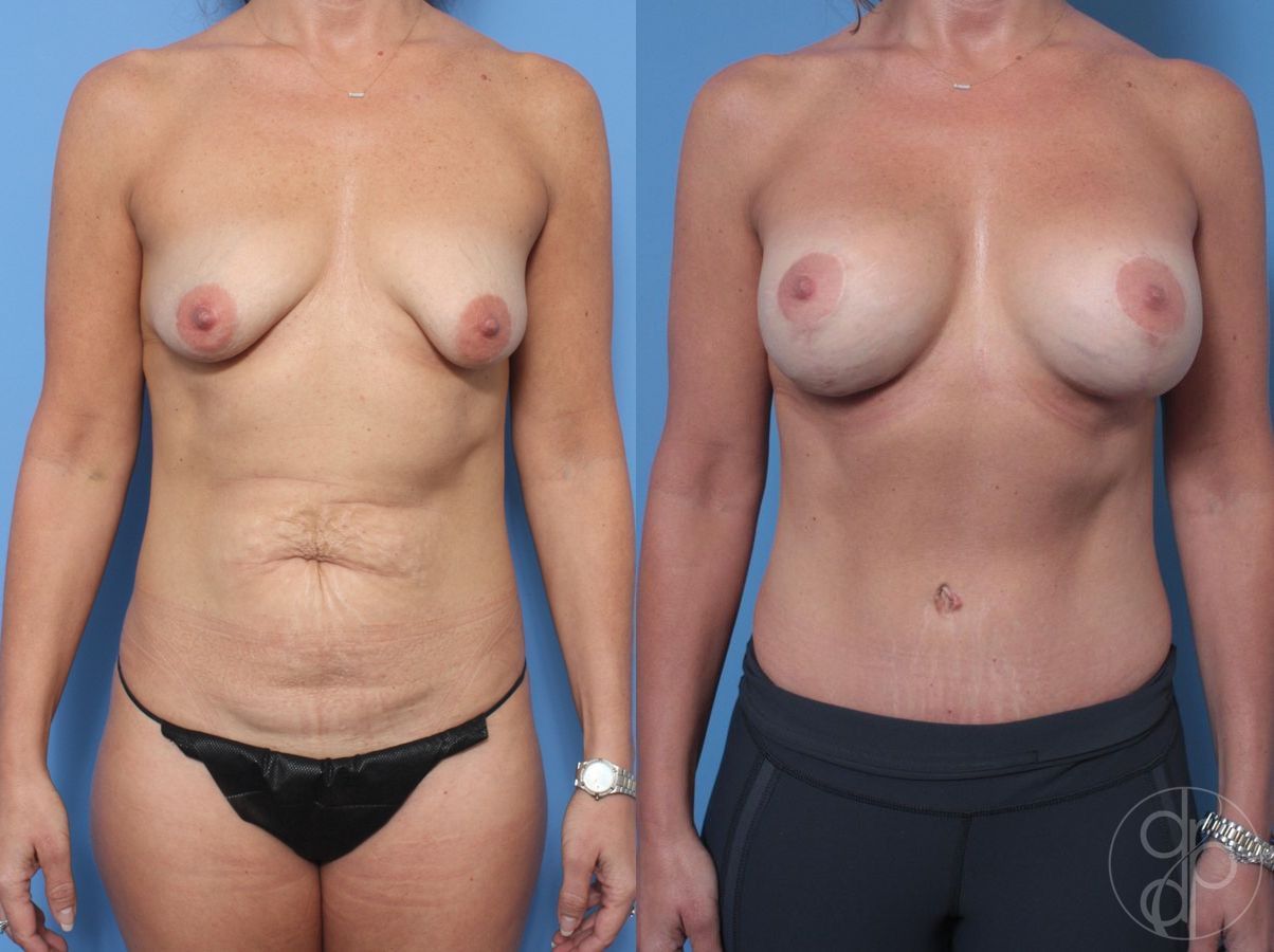 Before and after Mommy Makeover case 29890