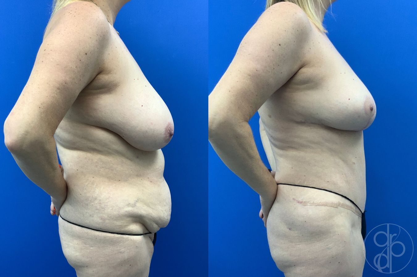Before and after Abdominoplasty case 46355 - Angle 6