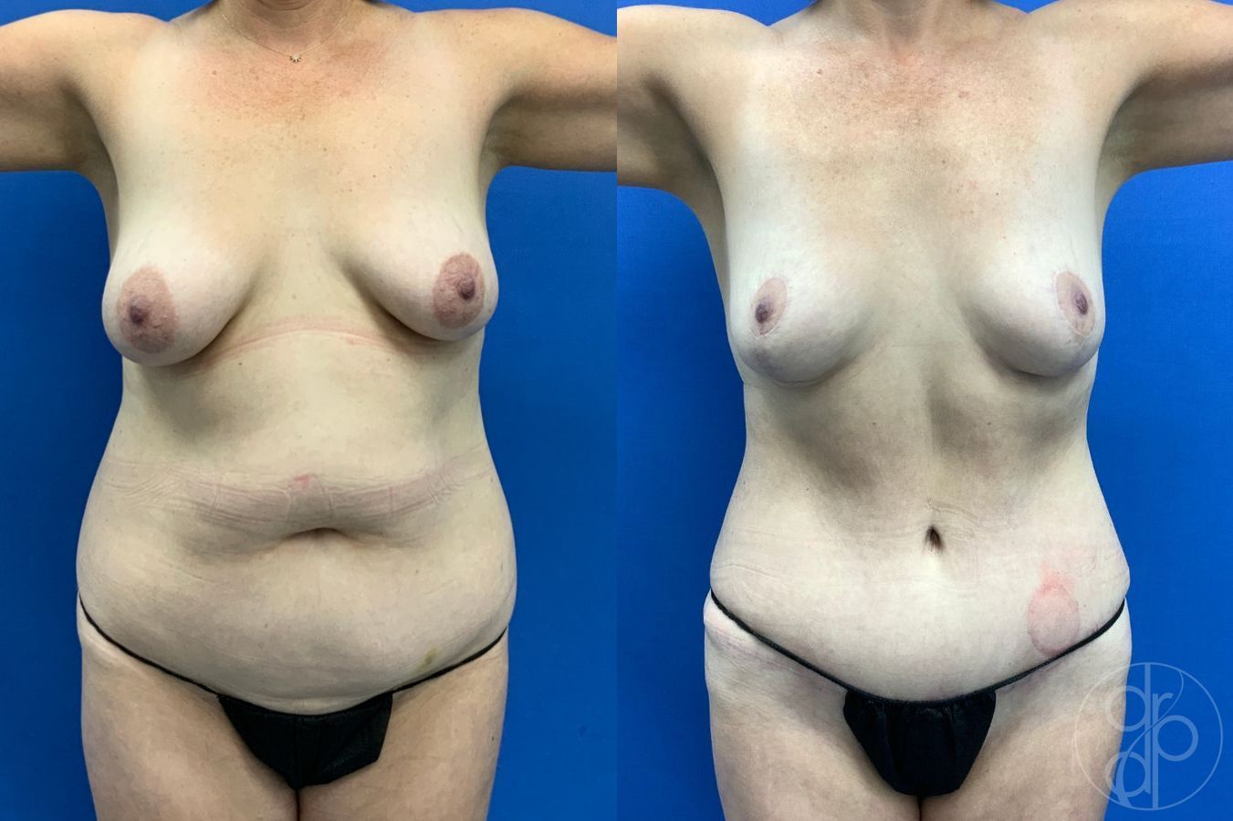 Before and after Abdominoplasty case 46268 - Angle 2
