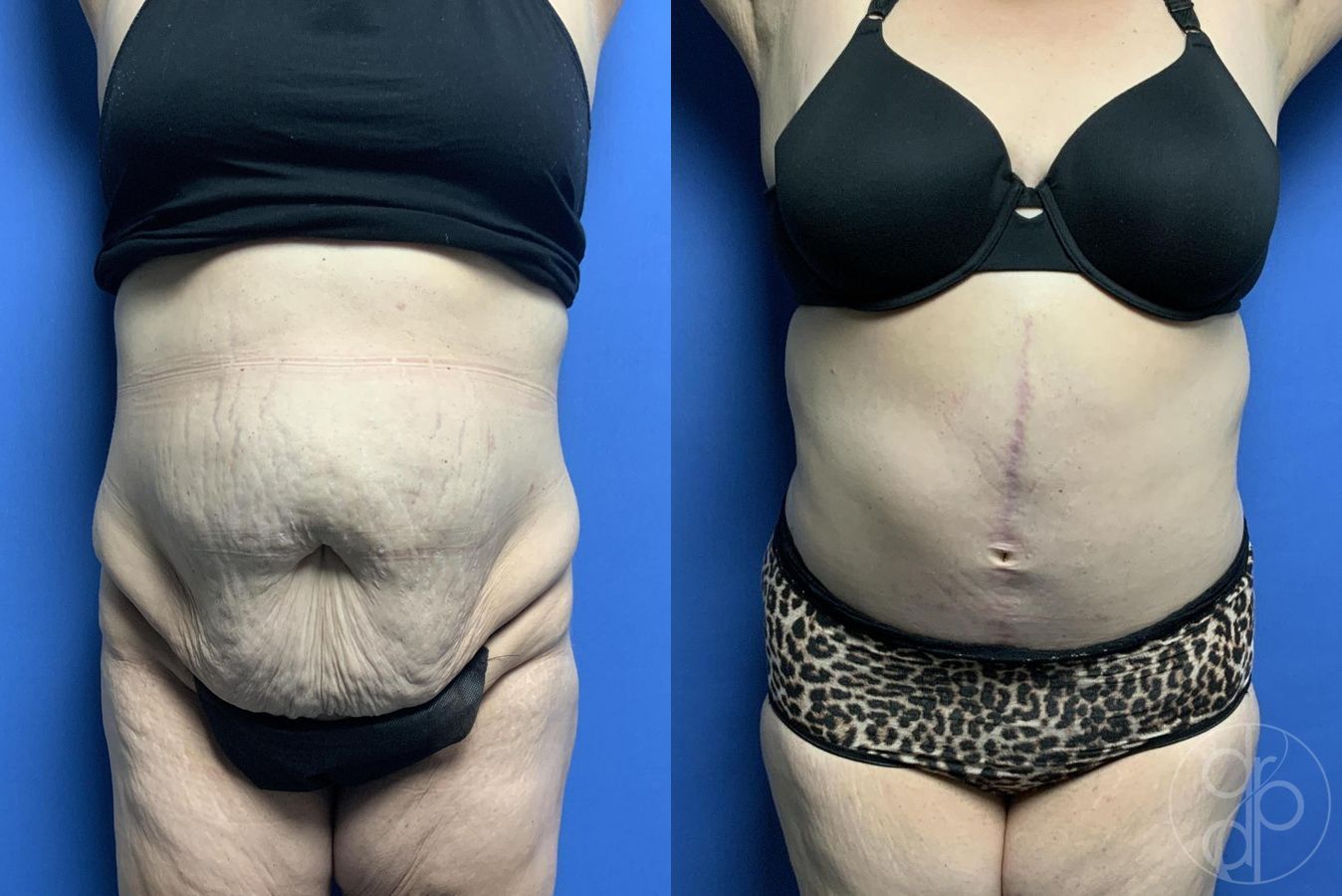 Before and after Mommy Makeover case 29982
