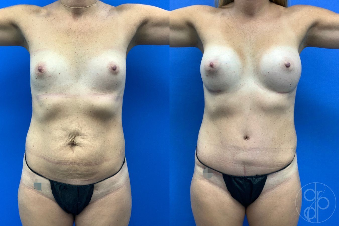 Before and after Mommy Makeover case 46378 - Angle 2