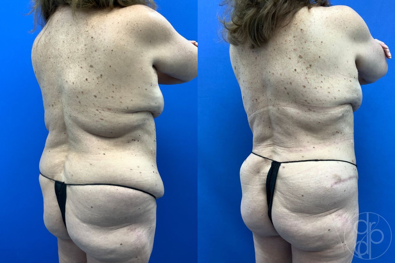 Before and after Liposuction case 46273 - Angle 6