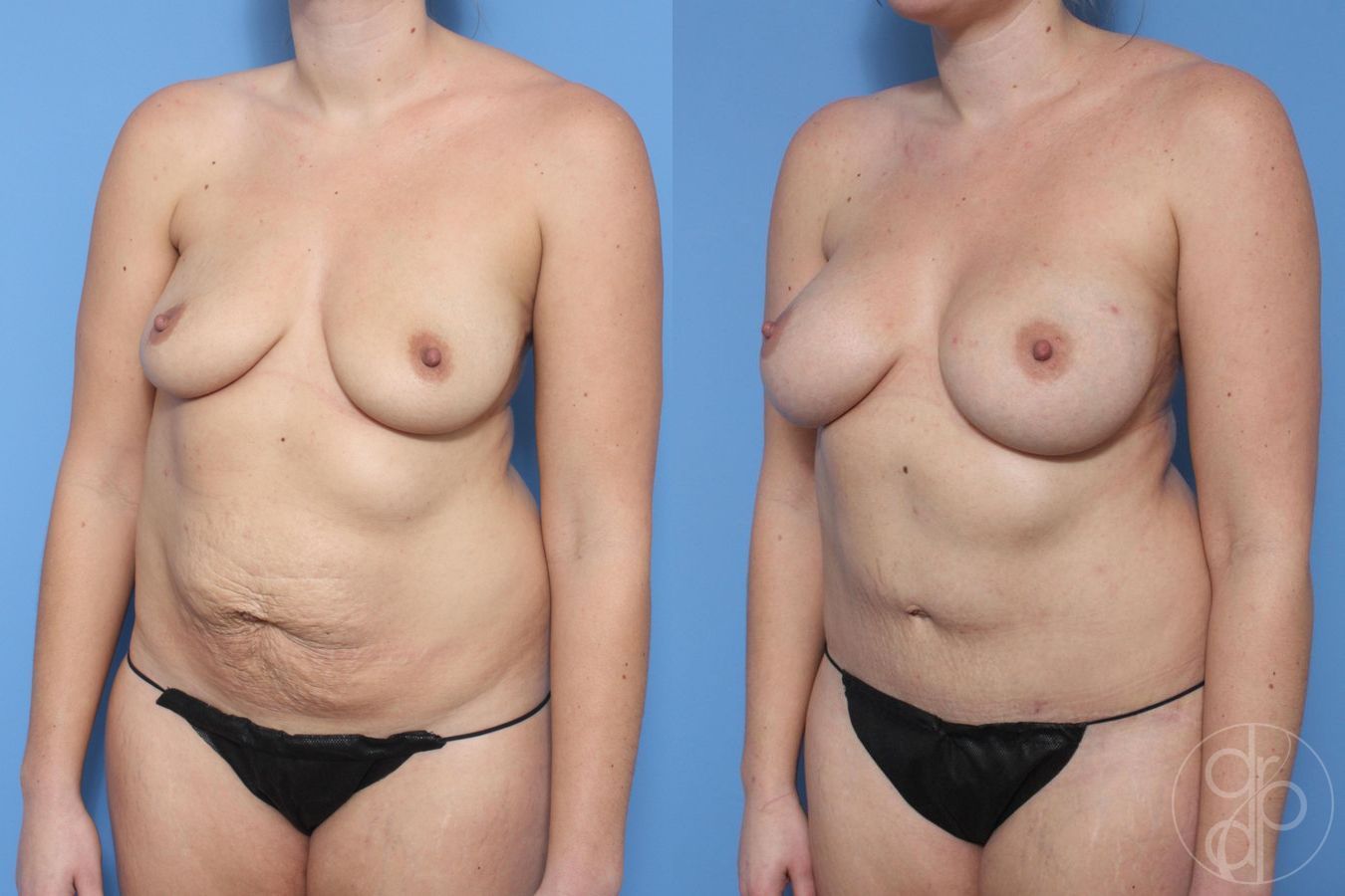 Before and after Mommy Makeover case 29618 - Angle 3