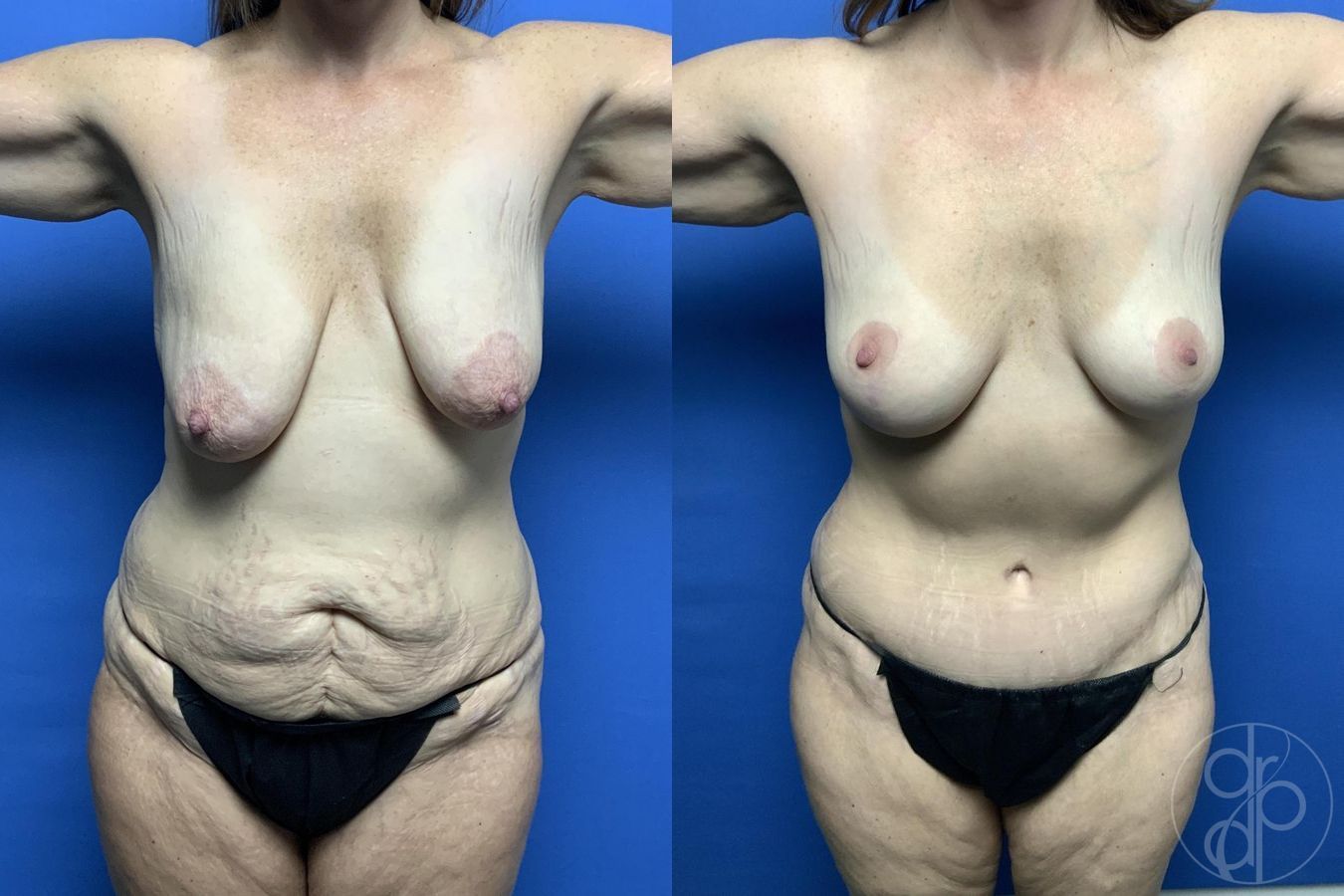 Before and after Mommy Makeover case 29976 - Angle 2