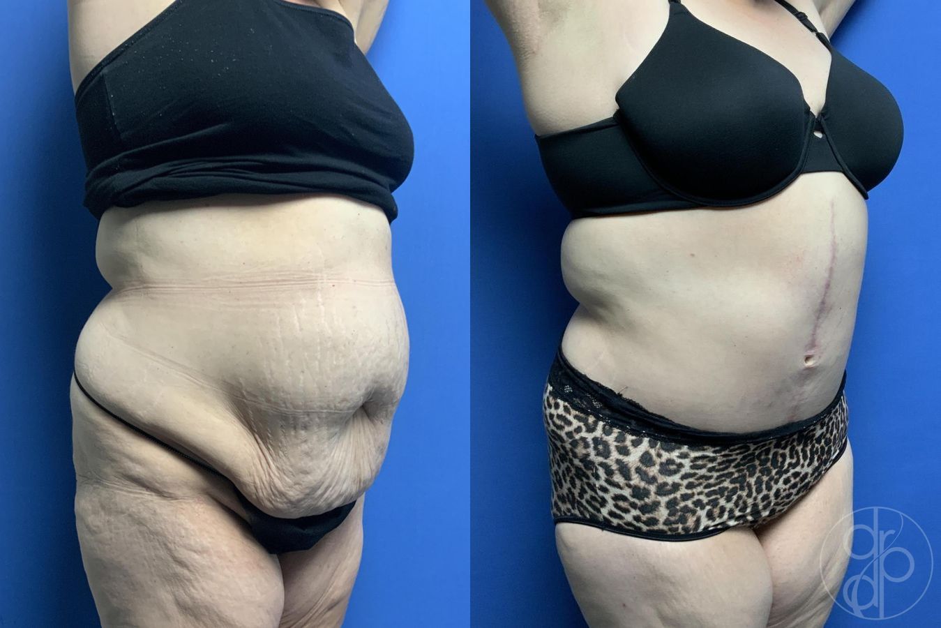 Before and after Mommy Makeover case 29982 - Angle 2