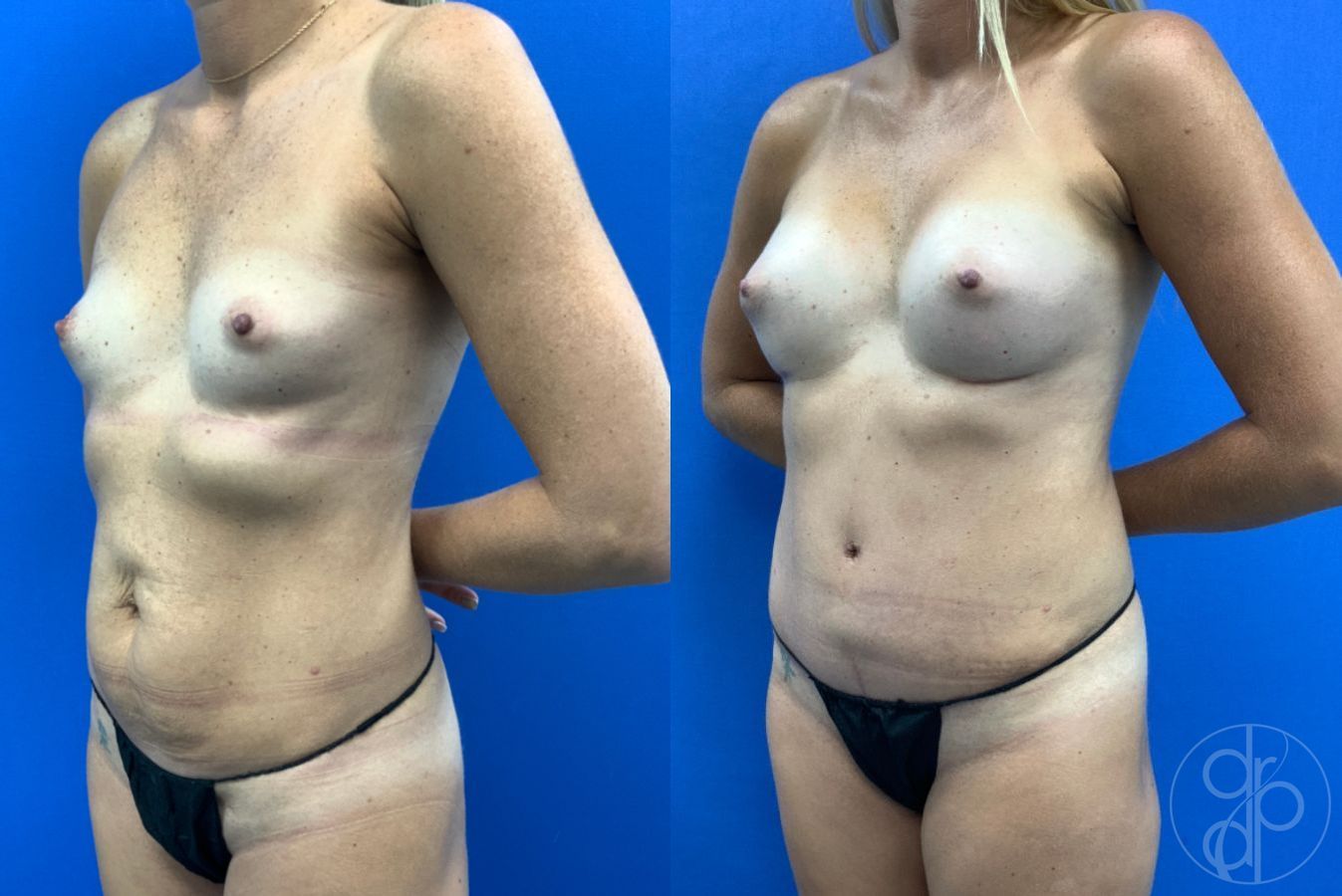Before and after Mommy Makeover case 46378 - Angle 3