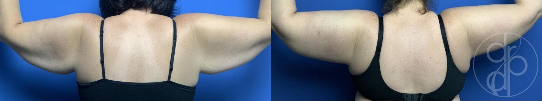 Before and after Abdominoplasty case 29982 - Angle 8