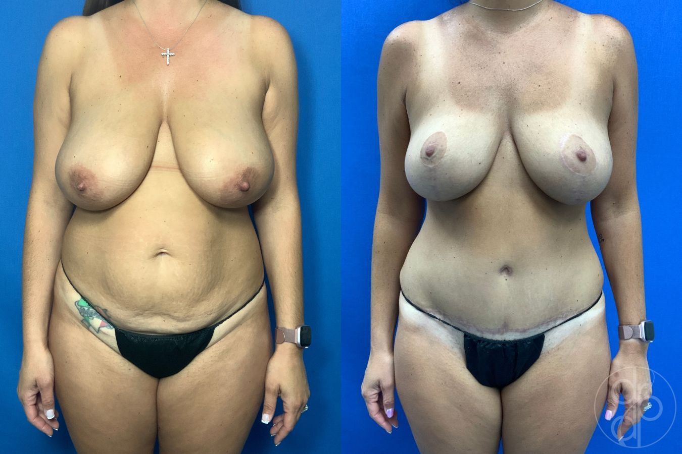 Before and after Mommy Makeover case 43479