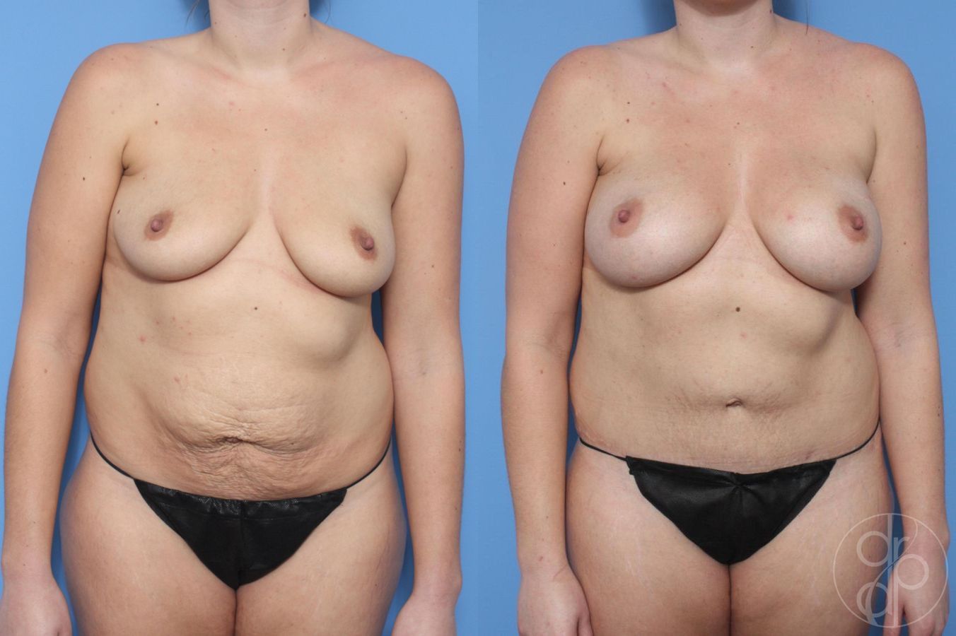 Before and after Mommy Makeover case 29618