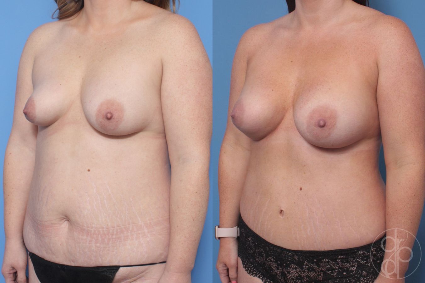 Before and after Tubular Breast Surgery case 29829 - Angle 3