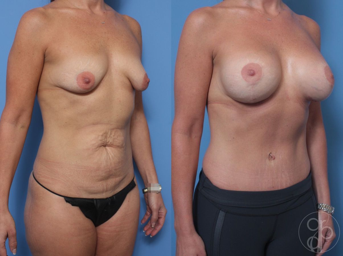 Before and after Mommy Makeover case 29890 - Angle 3