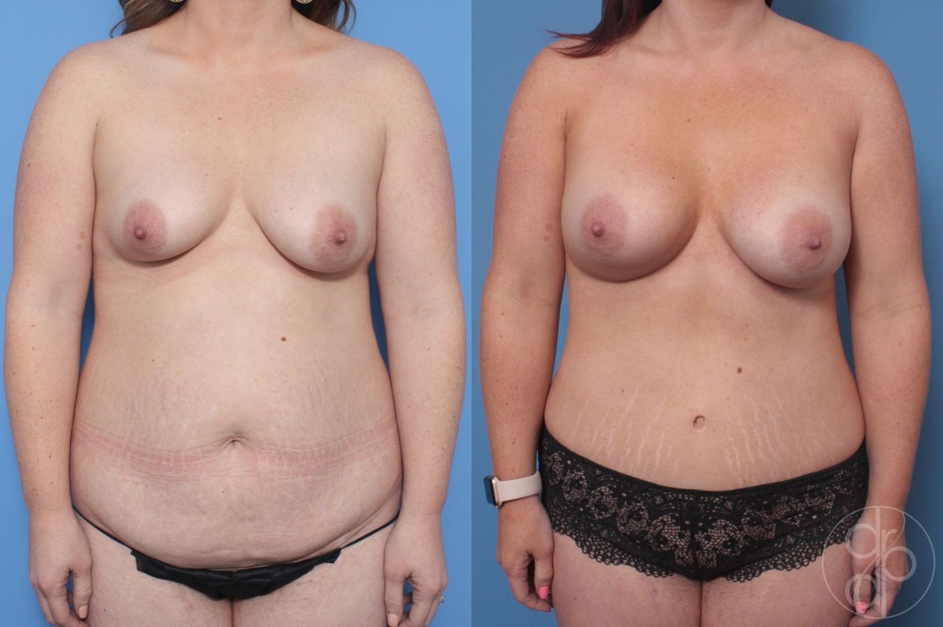 Before and after Mommy Makeover case 29829