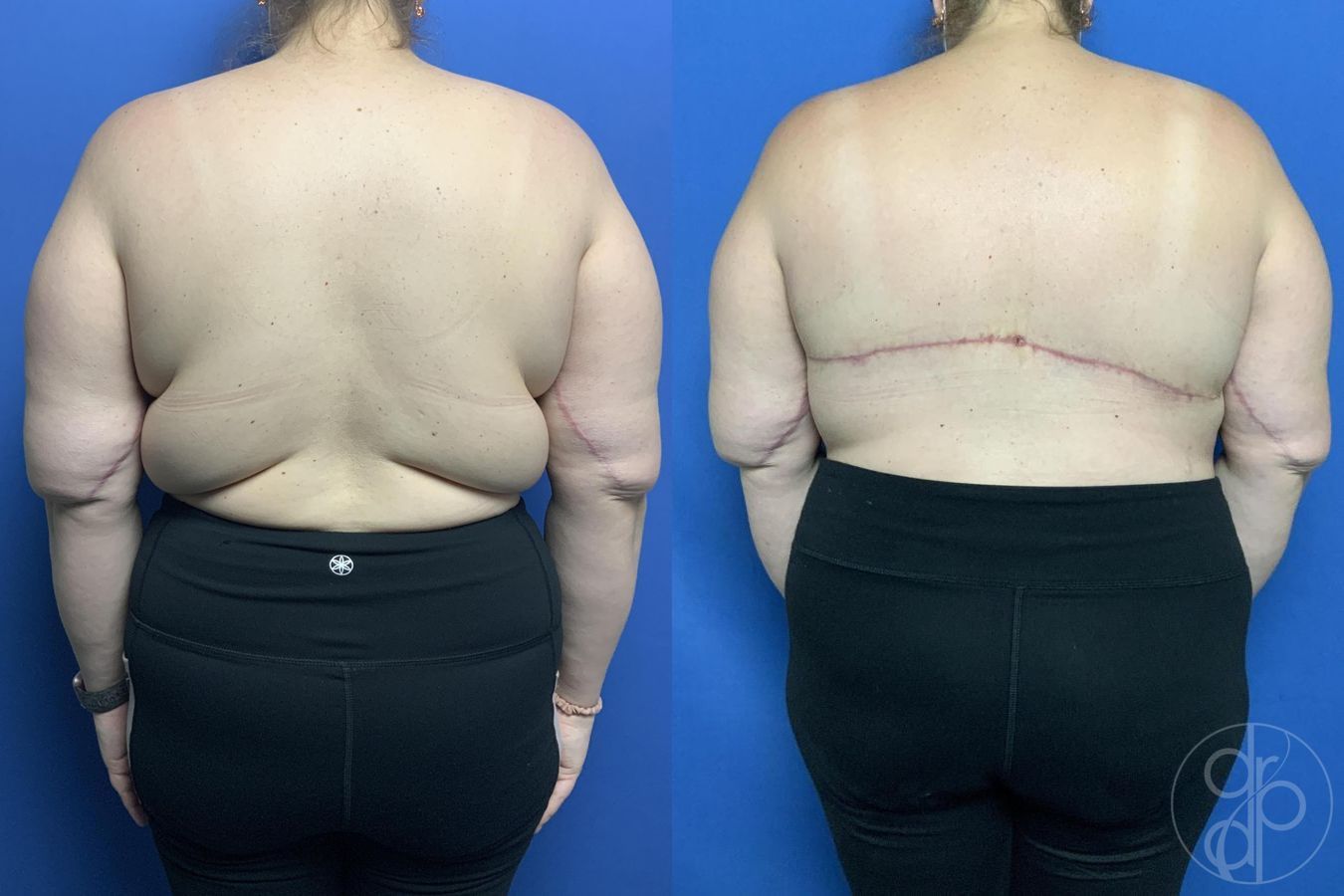 Before and after Mommy Makeover case 29982 - Angle 7