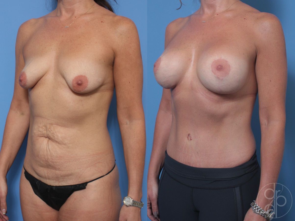 Before and after Mommy Makeover case 29890 - Angle 2