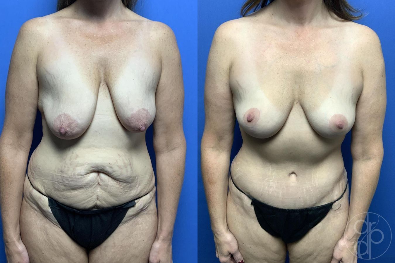 Before and after Mommy Makeover case 29976
