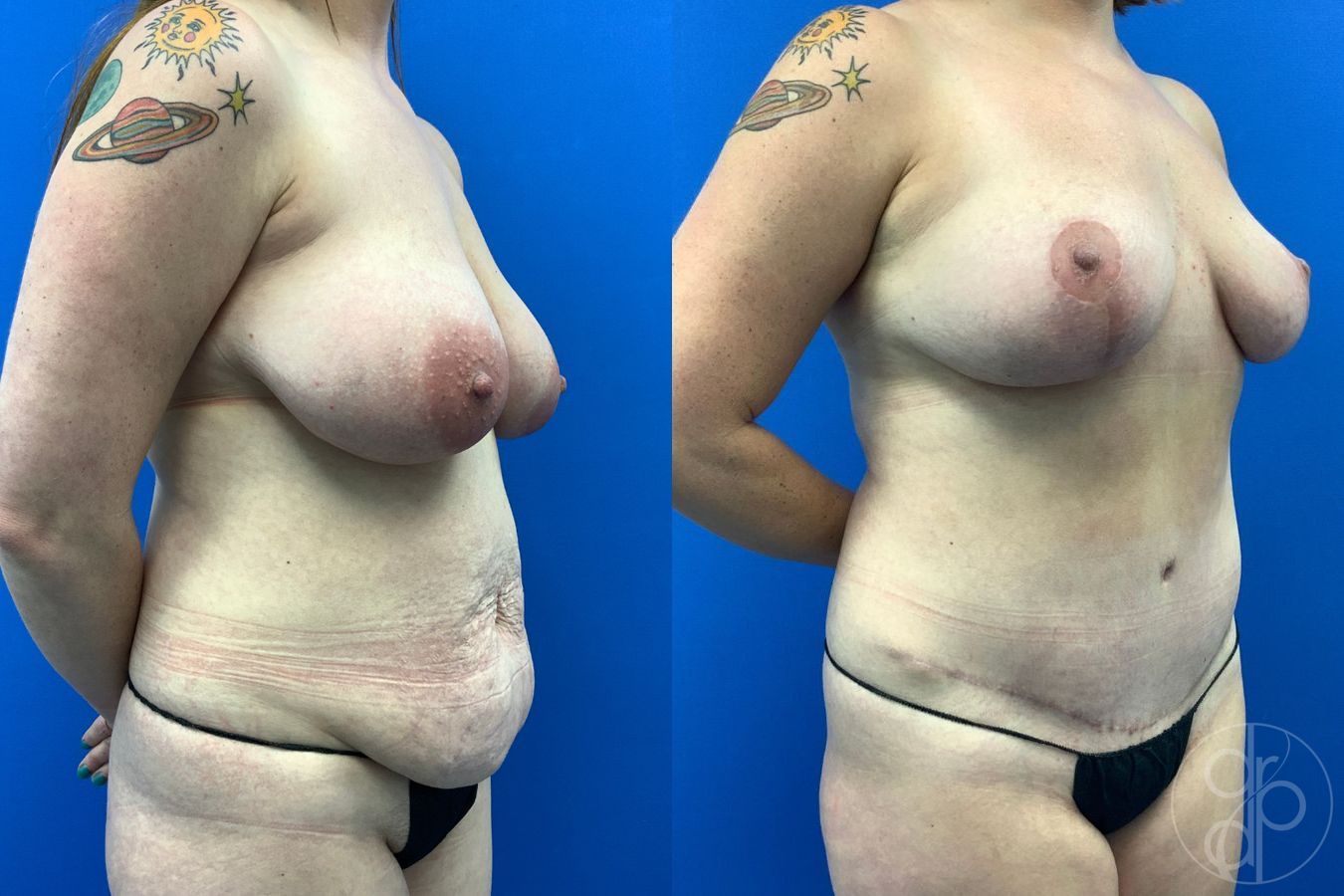 Before and after Mommy Makeover case 43477 - Angle 4